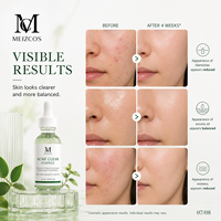 Essence anti-acné 30 ml, acide salicylique, polyquaternium, quaternium-73, extraits d'herbes, équilibre du sébum, clarifiant des pores, sérum pour la peau