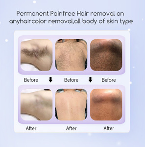 KM TERBARU <span class=keywords><strong>2026</strong></span> Diode Laser 3 Panjang Gelombang Diode Laser Penghilang Rambut Permanen dengan Laser Diodo Ice - Product Image 5