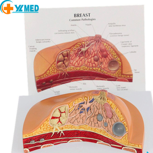 نموذج سرطان الثدي الأنثوي بالحجم الطبيعي نموذج فحص الثدي المرضي للإناث نماذج تشريحية للتعليم الطبي - Product Image 2