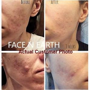 Soins de la peau biologiques en marque privée, crème hydratante anti-acné, anti-rides, anti-taches brunes, blanchissante, crème pour le visage contre l'acné - Product Image 2