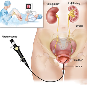 Ureteroscópios Descartáveis Seguros e Acessíveis, Dispositivo Médico Flexível de Uso Único para Diagnóstico de Urologia - Product Image 6