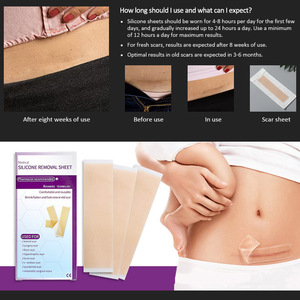 Patchs cicatrisants en gel de silicone imitant la peau artificielle, atténuent les cicatrices post-opératoires, les cicatrices neuves et anciennes, les cicatrices hypertrophiques, les brûlures. - Product Image 2