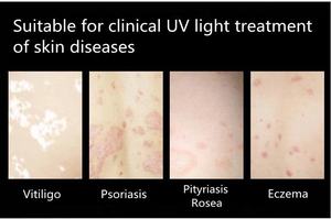 Lampu Laser Excimer UVB 308nm KN-5000D untuk Pengobatan Vitiligo - Product Image 6