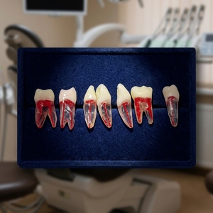 Simulatore Dentale per Pratica di Esame Odontoiatrico: Denti con Canale Radicolare e Cavità Pulpare Riempita in Resina - Product Image 1