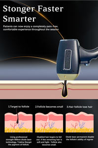Máquina de Depilación Láser de Diodo 4 en 1, 808nm, 755nm, 1064nm, 3 Longitudes de Onda, para Cuidado de la Piel, Uso Doméstico, Spa, Belleza - Product Image 4