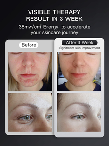 Giá thấp LED liệu pháp ánh sáng mặt nạ thông minh mặt nạ LED trị liệu du lịch chăm sóc da liệu pháp ánh sáng đỏ Led Mặt Nạ Silicone - Product Image 6