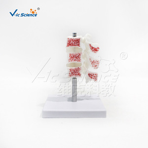 Modèle anatomique de colonne lombaire malade, modèle d'ostéoporose VIC-L034, ostéoporose de fémur humain. - Product Image 1