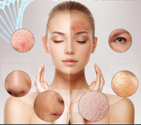 Appareil exfoliant pour la peau, éliminateur de points noirs, lame d'exfoliation ultrasonique, outil de beauté, massage vibrant, acier inoxydable