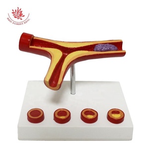 Modèle d'anatomie en PVC <span class=keywords><strong>vasculaire</strong></span> Matériau de haute qualité fait à la main Athériosclérose et thrombose Modèle de <span class=keywords><strong>pathologie</strong></span> des vaisseaux sanguins - Product Image 4