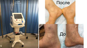 Système de <span class=keywords><strong>photorajeunissement</strong></span> 4 en 1 pour l'élimination des varices de l'araignée 980nm avec machine Beacuty pour les soins de la peau - Product Image 5