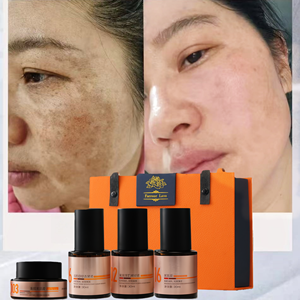 Iperpigmentazione causata da metalli pesanti nei cosmetici 4 In1 macchia della pelle Melasma per la pigmentazione del viso Peel rimuovere il Set di trattamento - Product Image 1