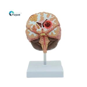Modèle de <span class=keywords><strong>pathologie</strong></span> du cerveau humain avec hémorragie et malformation <span class=keywords><strong>vasculaire</strong></span> pour l'enseignement de l'anatomie - Product Image 1