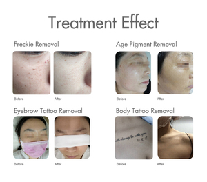 Machine de suppression de tatouages au <span class=keywords><strong>laser</strong></span> Nd:YAG à impulsions longues avec 532 nm et 1064 nm pour usage en salon/spa - Product Image 6
