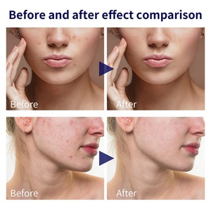 Suero de Ácido Hialurónico al por Mayor de 30 ml para el Cuidado Facial, Solución Correctora para la Eliminación de Manchas Oscuras - Product Image 6
