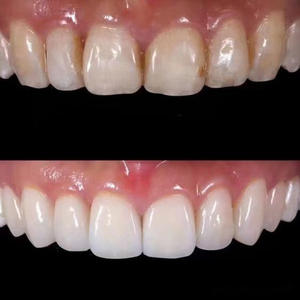 Facettes dentaires en porcelaine bleue tout céramique Dentsply Ivoire, faits à la main, en porcelaine ambrée, sans grincement des dents - Product Image 5