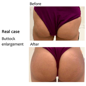 Heißeste Vakuum Schröpfen Thearpy Butt Lifting Maschine Brust massage gerät - Product Image 4