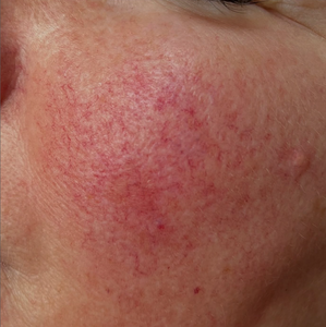 Mesin Laser Vaskular Portabel Diode Laser 980nm untuk Grosir, Dilengkapi Perangkat Penghilang Varises - Product Image 6