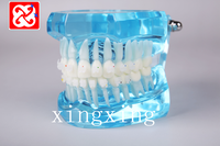 Pont de restauration de dents de maladie d'implant de modèle de Typodont dentaire standard pour le dentiste étudiant la Science médicale démontable de démo