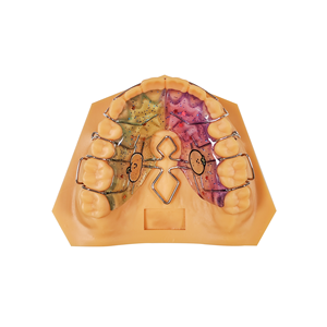 <span class=keywords><strong>Appareil</strong></span> orthodontique amovible Hawley en acrylique pour la rétention post-traitement et la personnalisation - Product Image 2