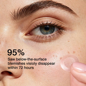 แผ่นแปะไมโครนีดเดิล OEM สำหรับดูแลสิว ช่วยฟื้นฟูผิว ลดรอยแดงและอาการบวม แผ่นแปะไมโครนีดเดิลแบบละลายน้ำได้สำหรับดูแลสิว - Product Image 5