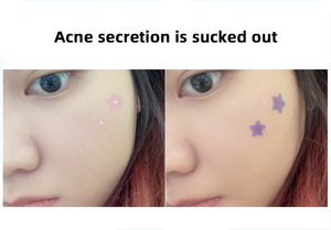 Bán hàng nóng biểu tượng tùy chỉnh mụn vá mụn Hydrocolloid dễ thương Sao Dán Mụn vá - Product Image 5