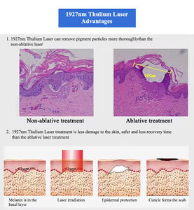 เครื่องเลเซอร์สำหรับกำจัดรอยกระชับผิว1927nm เพื่อความงามคลินิกสปา - Product Image 4