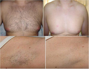 Лазерный аппарат для удаления волос Bios александрит, изготовленный в Германии, 755 александритовый лазер - Product Image 6