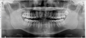 Appareil d'imagerie <span class=keywords><strong>panoramique</strong></span> et céphalométrique <span class=keywords><strong>dentaire</strong></span> simple d'utilisation, innovation en matière d'imagerie - Product Image 5