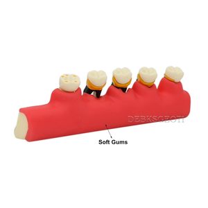 Modelo de Dientes Tipodonto para Demostración del Progreso de la Enfermedad Periodontal, Categoría Patología, para Enseñanza, Estudio y Demostración - Product Image 3