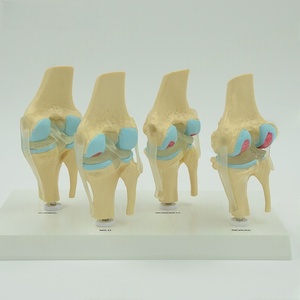 Le modèle de pathologie de l'articulation du genou en 4 étapes montre le processus de lésion de l'articulation du genou - Product Image 5
