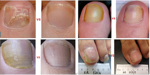 Láser de diodo de alta potencia de 60W, 980nm, hongos en las uñas de los pies/verrugas en los pies y dispositivo de eliminación de láser de onicomicosis - Product Image 6