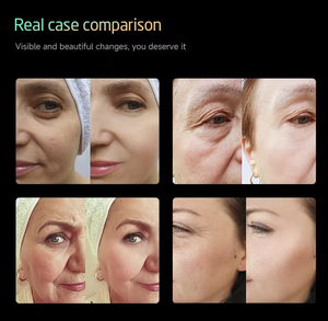 9 Cartridges 3 Handles Professional 360 Max 25d Face Machine Facial and Body Skin Firming 25D Beauty Machine - Product Image 6