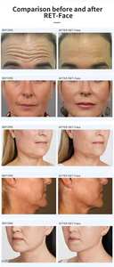 เทคโนโลยีใหม่ปี 2026 12D ทรีอินวัน ลดเลือนริ้วรอย กระชับสัดส่วนใบหน้าและร่างกาย ช่วยกระชับจุดซ่อนเร้น - Product Image 5