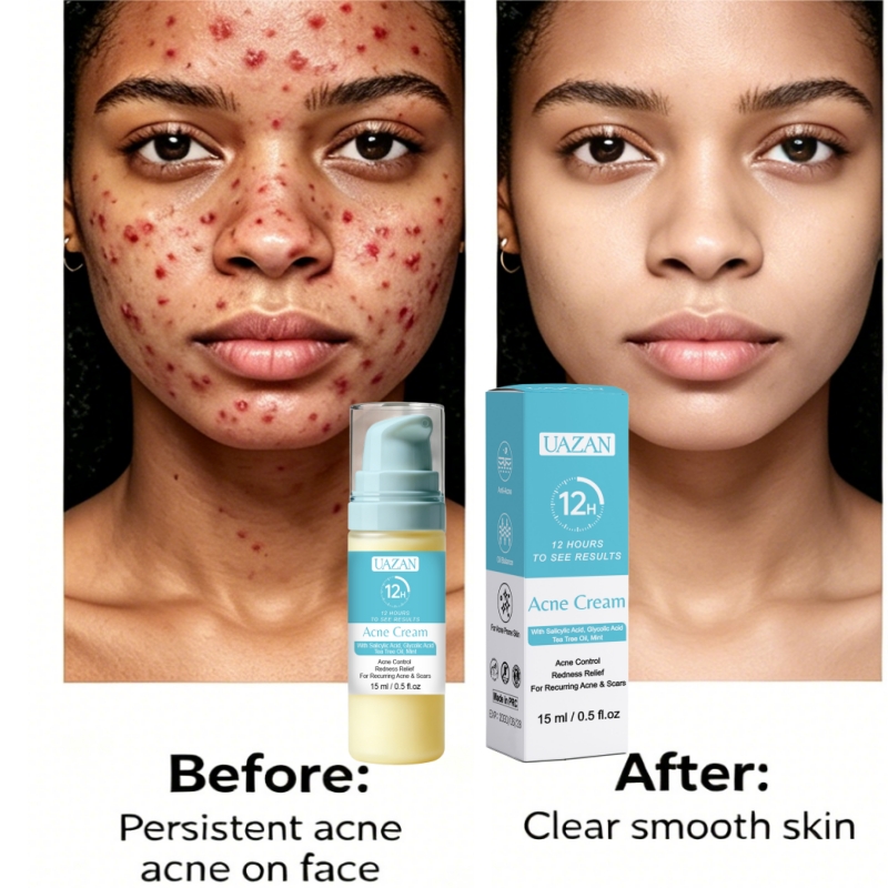 Wholesale Sulfate-Free Repair Pimple Scar Salicylic Acid Acne Cream Fast Effective Anti-Acne Oil Balance For Recurring Acne Scar
