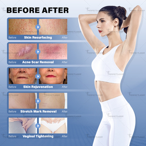 Perfectlaser CO2 fractional Máy Laser mới 2025 y tế <span class=keywords><strong>CE</strong></span> phê duyệt âm đạo thắt chặt 10600nm CO2 Laser Giá máy - Product Image 6