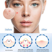 Patchs anti-acné hydrocolloïdes assortis en 5 tailles – Traitement jour et nuit pour les boutons – Couvre-grands points noirs – Pack varié pour le visage