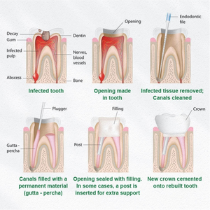 전동 치과용 장비 근관치료용 로터리 파일 우수한 품질 6개입/팩 - Product Image 6