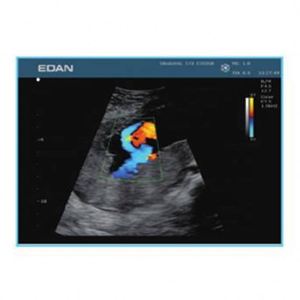 <span class=keywords><strong>Edan</strong></span> U50 Portable Color Doppler <span class=keywords><strong>Ultrasound</strong></span> Pemindai Ultrasonografi Superior - Product Image 6