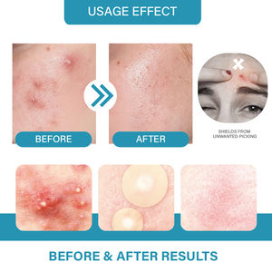 Puistje Pleister Acne Pad Huidproblemen Zorg Patch Probleem Cure Patch Puistje - Product Image 6