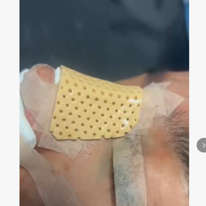 Férula Nasal Termoplástica <span class=keywords><strong>Aquaplast</strong></span> para Rinoplastia, Cirugía de Nariz, Rehabilitación de Fracturas, Inmovilización, Soporte y Fijación - Product Image 2