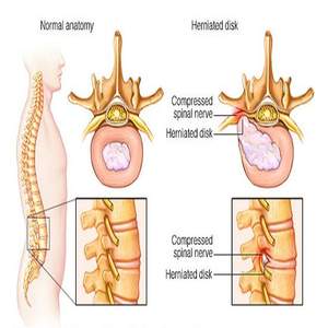Descompresion laser diodo <span class=keywords><strong>intradiscal</strong></span> 980nm 1470nm PLDD disco spinale fisioterapia per ernia disco medico chirurgico macchina - Product Image 5