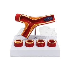 Modelo de Trombosis, Modelo Anatómico de <span class=keywords><strong>Arteriosclerosis</strong></span> Cardiovascular Humana - Product Image 1