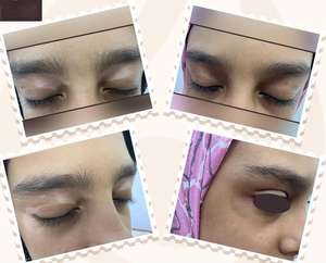 Kernelmed-<span class=keywords><strong>Tratamiento</strong></span> con láser excimer para condiciones como la psoriasis, el vitiligo y el <span class=keywords><strong>eczema</strong></span>, el ultravioleta B (UVB) UVB 308, con láser de Excimer, para el <span class=keywords><strong>tratamiento</strong></span> de condiciones como la psoriasis - Product Image 5