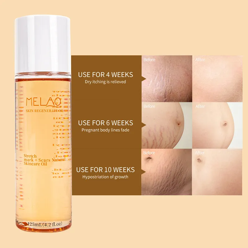 Custom Private Label Stretch Marks Removal Vergetures Oil