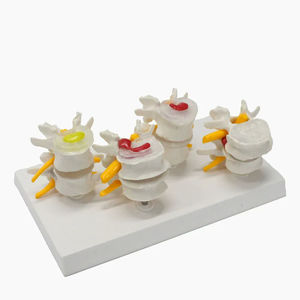 인간 척추 모델에서 정상 요추 및 4 단 요추 디스크 허리 병변 모델 - Product Image 4