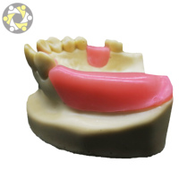 Modèle d'implant dentaire personnalisable pour la science médicale, avec dent manquante en résine, 11x10x6 cm, pour l'enseignement et la pratique