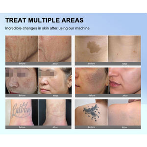 Équipement de <span class=keywords><strong>laser</strong></span> picoseconde le plus populaire, machine de suppression de tatouage Nd Yag au <span class=keywords><strong>prix</strong></span> Picocare Beauty <span class=keywords><strong>Laser</strong></span> - Product Image 6