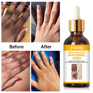 Suero Vegano para Manos, Codos y Rodillas, Eliminador <span class=keywords><strong>de</strong></span> <span class=keywords><strong>Manchas</strong></span> Intensas, <span class=keywords><strong>Corrector</strong></span> <span class=keywords><strong>de</strong></span> Pigmentación, Antiarrugas y Blanqueador para Piel Negra - Product Image 5