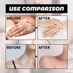 OUHOE Vente en gros 30ml Spray de traitement du vitiligo, anti-<span class=keywords><strong>taches</strong></span> <span class=keywords><strong>blanches</strong></span>, teigne, leucoplasie cutanée, dermatite - Product Image 4