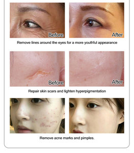 Appareil professionnel de microneedling fractionné par radiofréquence avec aspiration pour le lifting du visage et l'élimination des vergetures corporelles, avec marteau froid - Product Image 6